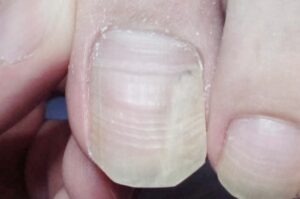 爪甲溶解症の一般的な原因は何ですか?